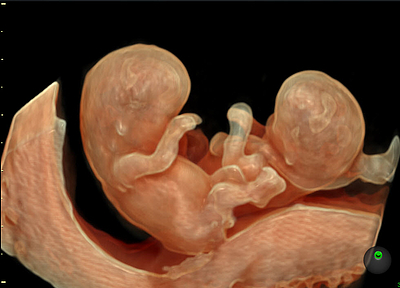 Ultraschallbild von 9-Wochen alten Zwillingen